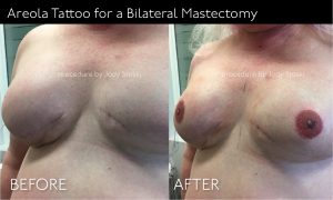 Areola Tattoo for Bilateral Mastectomy