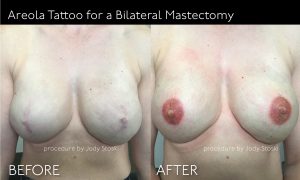 Areola Tattoo for Bilateral Mastectomy