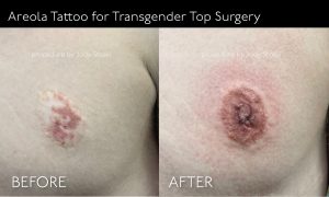 Areola Tattoo for Transgender Top Surgery