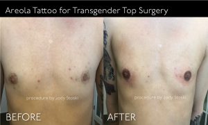 Areola Tattoo for Transgender Top Surgery
