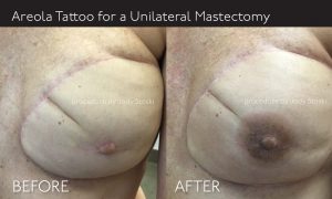 Areola Tattoo for Unilateral Mastectomy