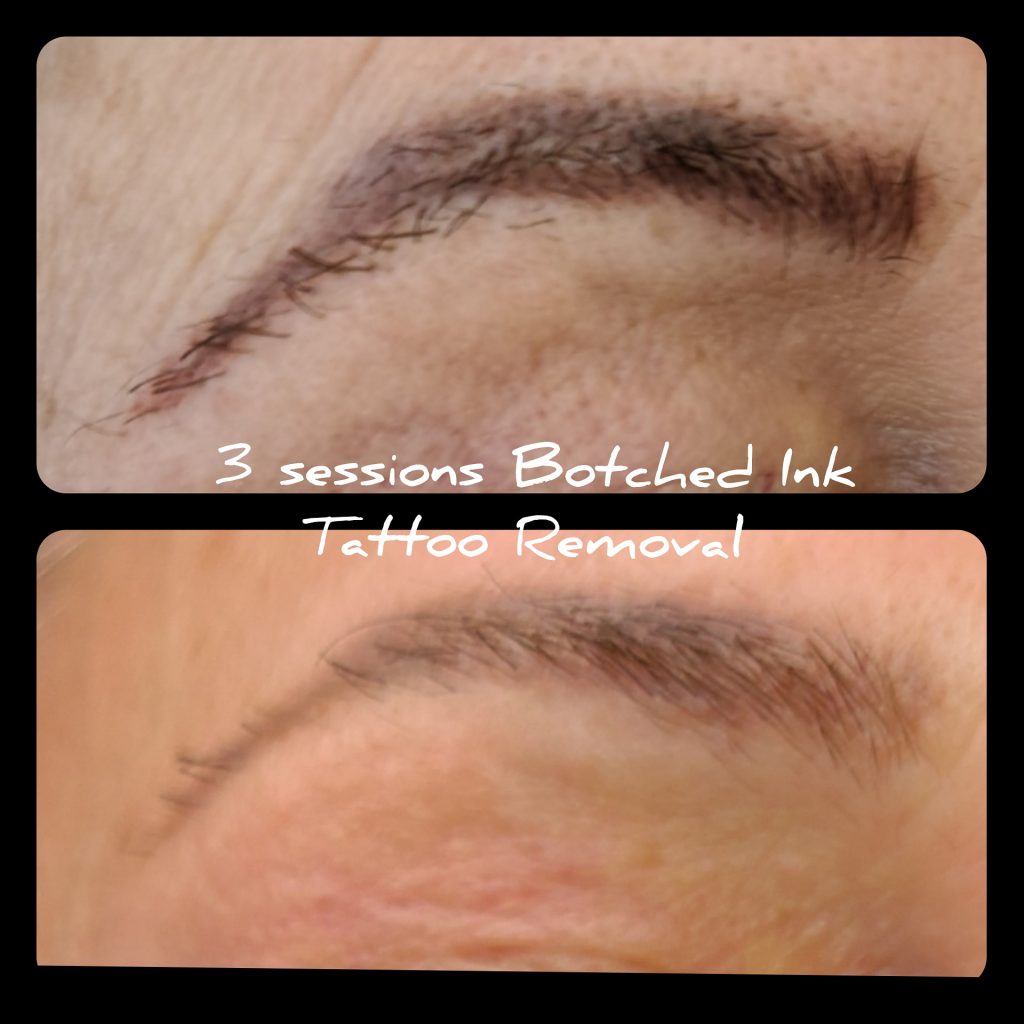 Microblading Removal using saline solution The Beauty House