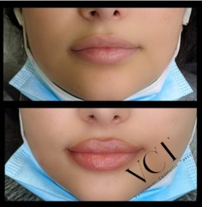 Before and After Photo for lip blush tattoo