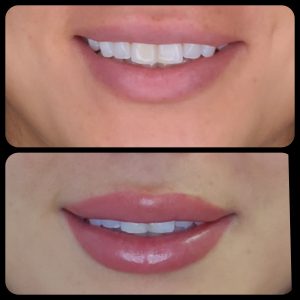 before and after photo of lip blush