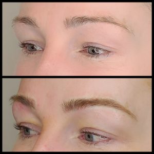 Vancouver Microblading Removal  Permanent Makeup Removal Does It Work