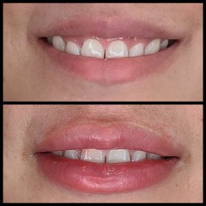 before and after photo of lip blush