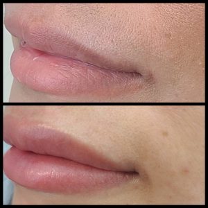 before and after photo of lip blush